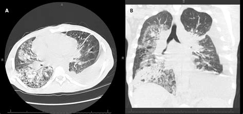 Non Invasive Diagnosis Of Pulmonary Kaposi Sarcoma A Case Report