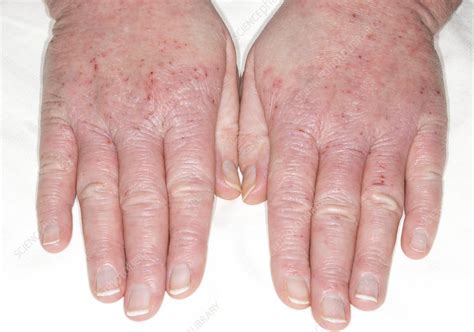 Eczema Of The Hands Stock Image C0194112 Science Photo Library