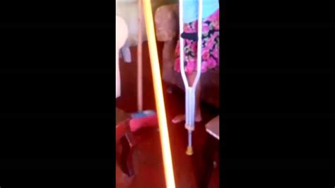Female Leg Amputee Walking With One Crutch Youtube