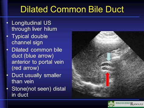 Dilatation Common Bile Duct Slidesharetrick