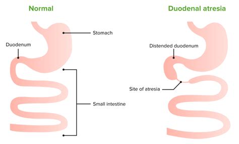 Congenital Duodenal Obstruction Concise Medical Knowledge