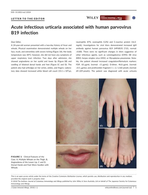 Pdf Acute Infectious Urticaria Associated With Human Parvovirus B19