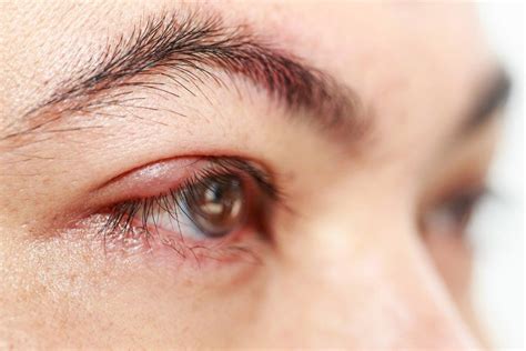 Causes Of And Treatments For Excessive Eye Tearing