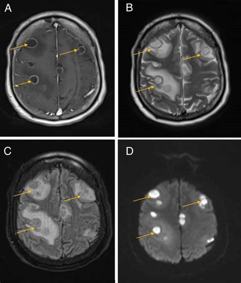 Cureus Multiple Brain Abscesses Due To Nocardia Otitidiscaviarum