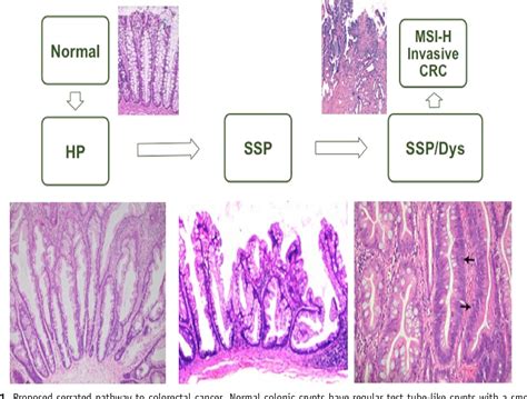 Sessile Serrated Polyps And Colon Cancer Prevention CancerWalls