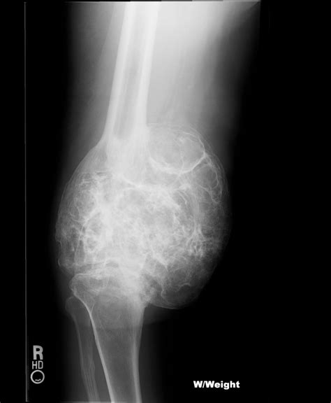 Osteoblastoma Radiology Case