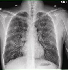 For general discussion of cystic. 9 CXR ideas | radiology, pulmonology, radiology imaging