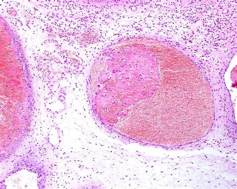 Massons Tumour Photograph By Jose Calvo Science Photo Library Pixels