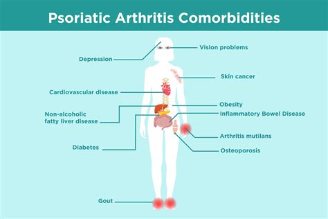 Psoriatic Arthritis Comorbidities What Patients Need To Know