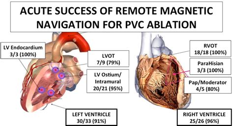 Acute And Longitudinal Efficacy With Remote Magnetic Navigation For Pvc