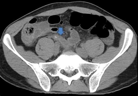 Appendicitis On Ct Scan