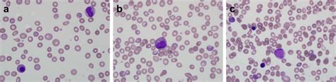 Peripheral Blood Smear A B Leukoerythroblastic Changes Including