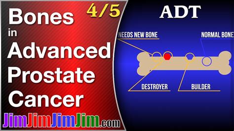 Hormone Therapy Adt For Prostate Cancer Bones Youtube