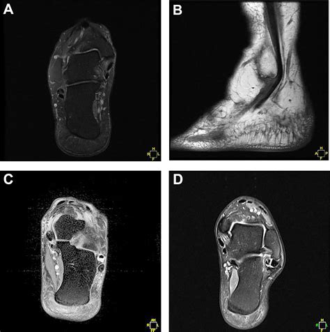 Diagnosis And Operative Treatment Of Peroneal Tendon Tears Natalie R