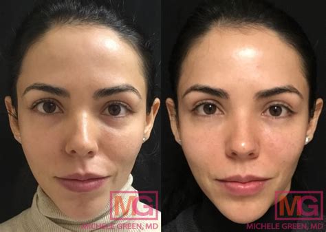 Non Surgical Cheek Lift Dr Michele Green Md