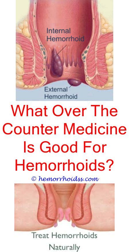 The skin around the clotted hemmeroid is bluish in color. How To Treat Hemorrhoid Thrombosis? what medicine gets rid of hemorrhoids?.Can You Put Vicks ...