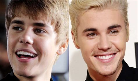 Top Celebrities Who Have Used Invisalign And Braces