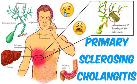 Deciphering Primary Sclerosing Cholangitis Symptoms Diagnosis And