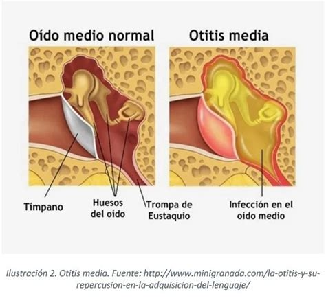 Enfermedades Del Oído Otitis Media Otitis Externa Acúfenos