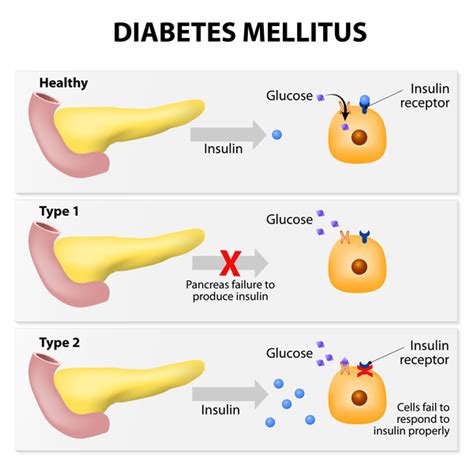 Learn about the types of diabetes and the advancement in treating the disease. Type 2 diabetes: MedlinePlus Genetics