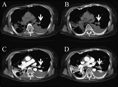 Post Mortem Contrast Enhanced Computed Tomography In A Case Of Sudden