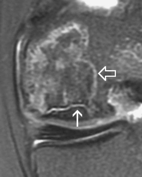 Avascular Necrosis Of The Knee Radiology Case