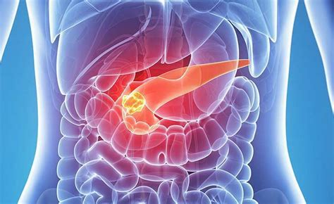 5 Key Facts About Pancreatic Neuroendocrine Tumors Pancreatic Cancer