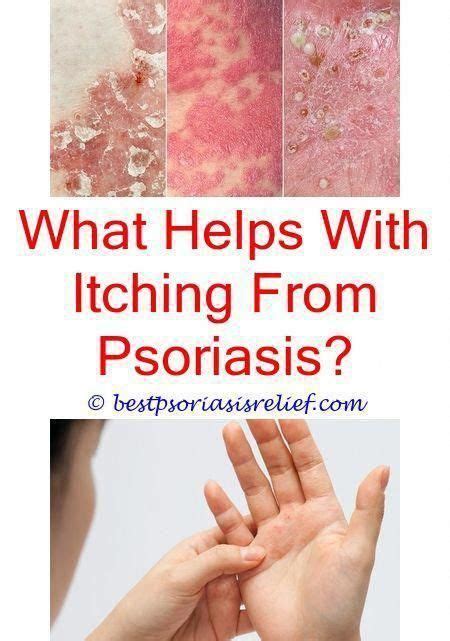 Everything You Need To Know About Psoriasis Scalp Psoriasis Causes
