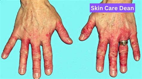 What Is Latex Allergy Symptoms Causes And Treatments Skin Care Dean