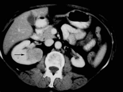 Contrast Enhanced Ct Scan Shows A Right Kidney Mass Suggestive Of
