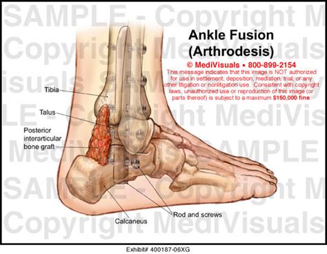 Ankle Fusion Arthrodesis Medical Illustration Medivisuals