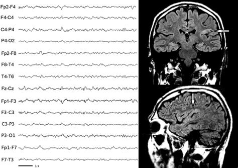 Interictal Electroencephalogram Of Patient 5 Low Voltage Download