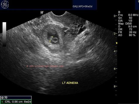 A Variety Of Ultrasound Images To Include Bicornuate Uterus With Gestation Sac Cornual Pregnany