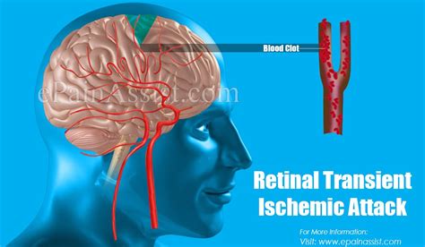 Transient Cerebral Ischemic Attack