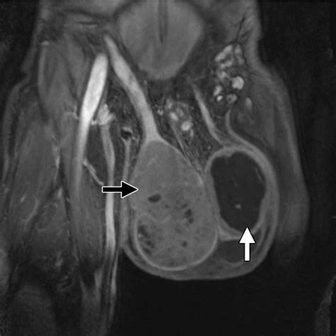 Mr Imaging Of The Penis And Scrotum Radiographics