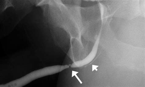 Retrograde Urethrogram In A Case Of Poor Urinary Stream There Is A