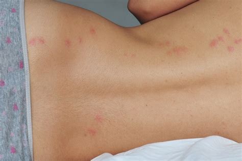 Bed Bug Bites What Do Bed Bug Bites Look Like My Xxx Hot Girl