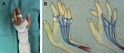 Management Of Complications Of Extensor Tendon Injuries Hand Clinics