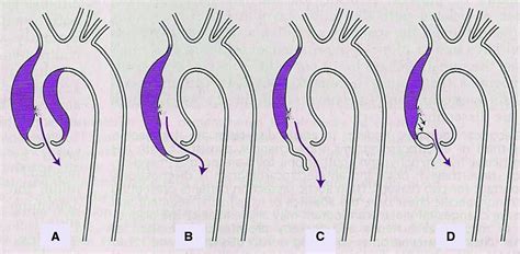 Acute Aortic Regurgitation Circulation