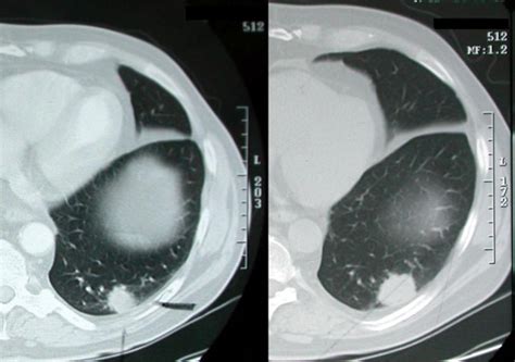 Chest Ct Scan Showing A 17 Cm Left Lower Lobe Nodule Left As Well