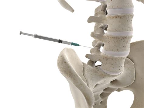 Spinal Injections And Medications Diagnosis And Treat Back Pain