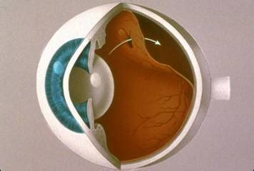 A detached retina has to be examined by an ophthalmologist right away. Retinal Tear | Krieger Eye