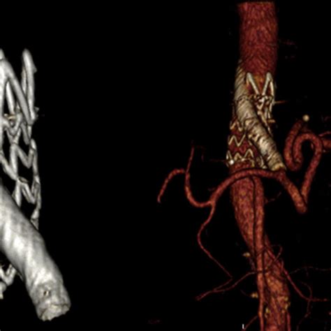 Computed Tomography Angiography Cta Three Dimensional Reconstructions