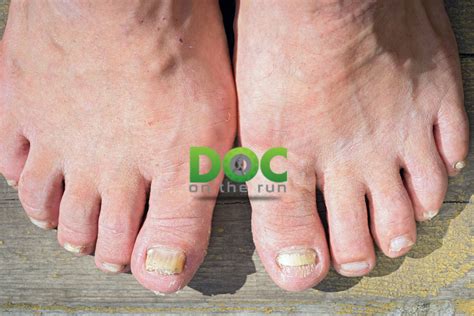 Top 5 Mistakes Runners Make With Their Toenails