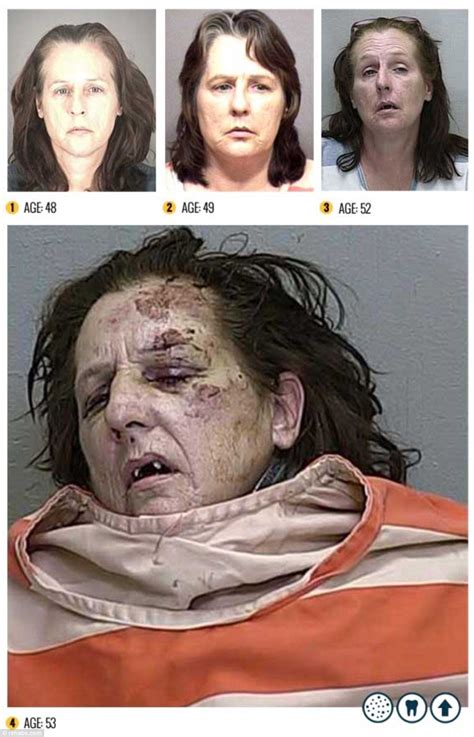 The Horror Of Meth Before And After Pictures Reveal Shocking