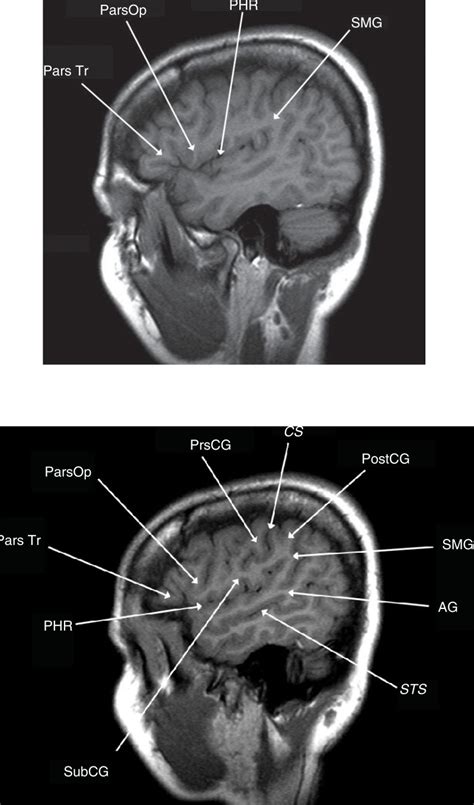 Figures 3 Lateral Sagittal T1 Weighted Mri Scans Glioblastoma