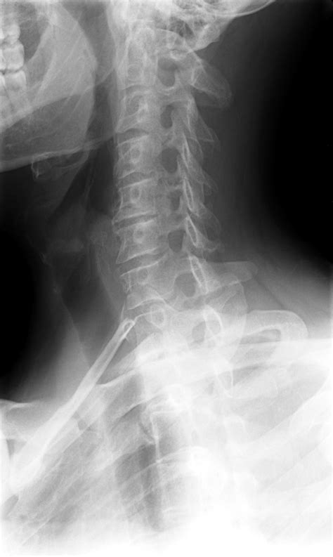 Cervical Xray Lower Lateral View Buyxraysonline