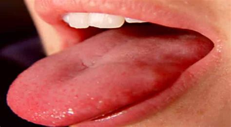 Why Pimples On Tongue Side Under Tip Side Or Back