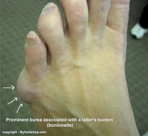 Tailors Bunions Causes And Treatment Options