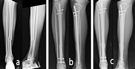 Tibial Shaft Fracture Treated With Mono Planar Distal Locking 2